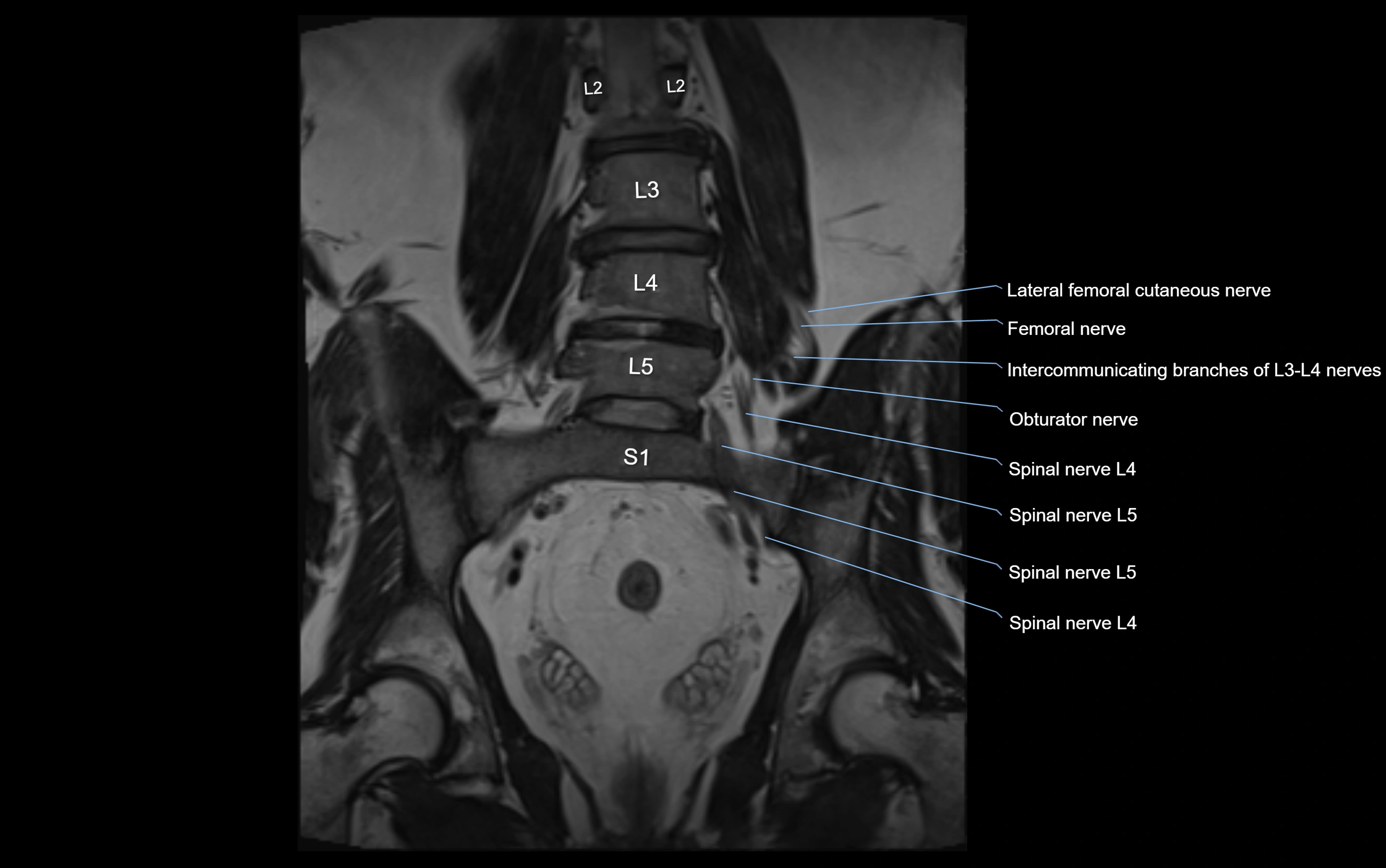 MR lumbosacral plexus cross sectional anatomy 3T  radiology  image-img-09001-00034.webp
